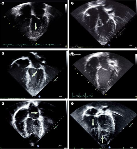 lv compaction|compaction vs non cardiomyopathy.